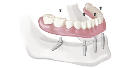 prothese dentaire sur implants